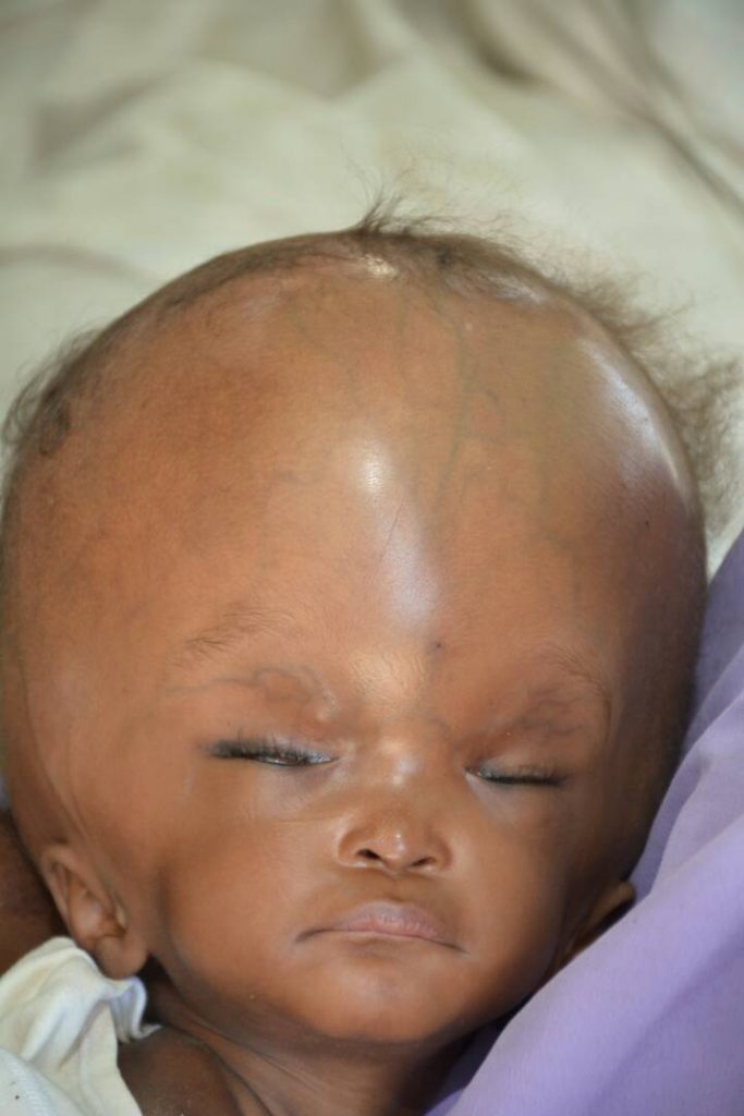 Nana Khadija Adamu 1 year hydrocephalus - THEWILL NEWS MEDIA