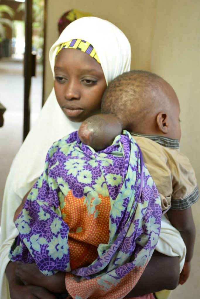 muhammad auwal adamu 1 year encephalocele - THEWILL NEWS MEDIA