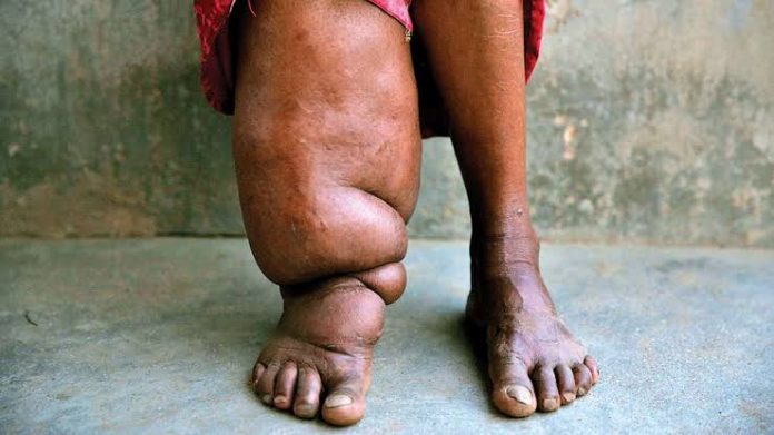 Lymphatic Filariasis