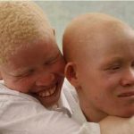 Skin Cancer Kills Three With Albinism In Anambra In Five Months – Group