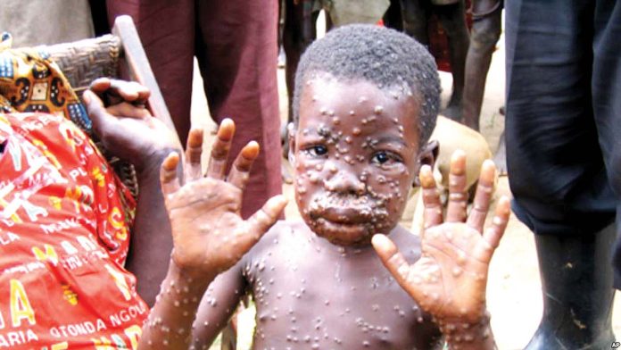 Monkey pox