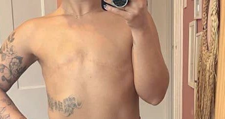 Masectomy on cancer survivor