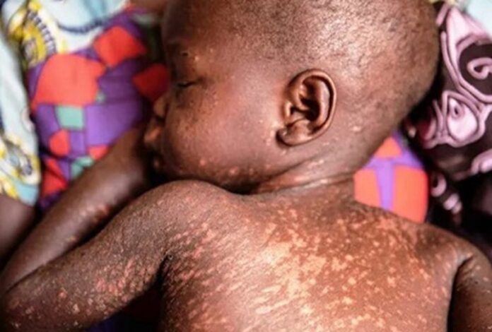 Measles